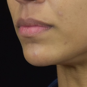 Chin Filler-after