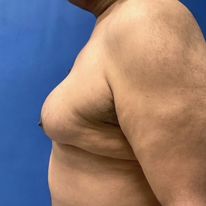 Male Breast Reduction #2-before