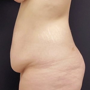 Tummy Tuck #7-before