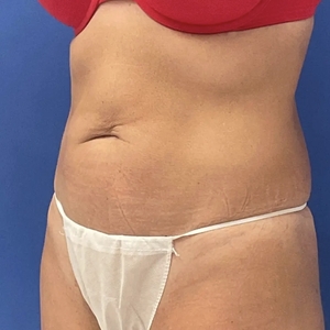 Tummy Tuck #15-before