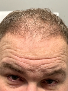 Neograft 1753 grafts-before