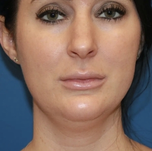 Lipo w Skin Tightening Face #1-before