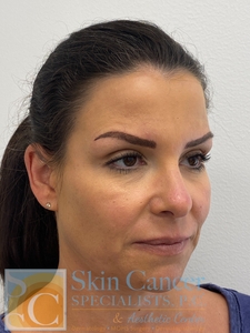 Voluma, Defyne and Botox-after