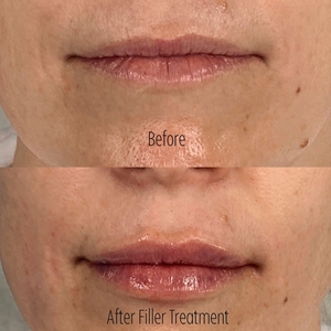 Filler B/A SBA 19-before