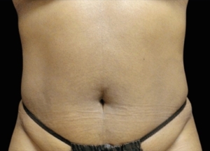 Emsculpt NEO #6-after