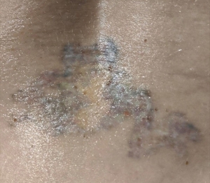 Laser Tattoo Removal #1-after