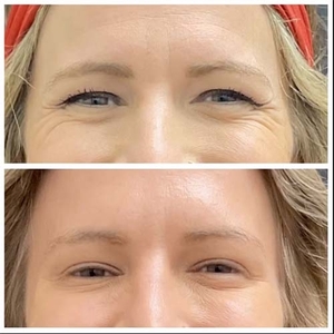 Botox-before