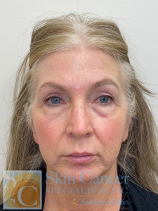 Nova Threads and Cheek Filler-before