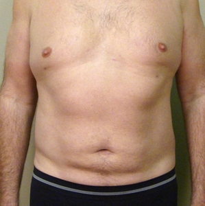 Liposuction #3-after