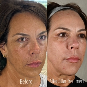 Filler B/A RB-before