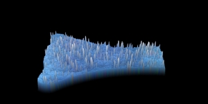 3D Pore Congestion on Cheek Before and After Hydroglow Facial-after