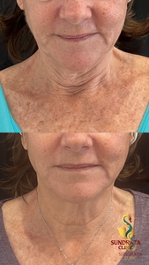 XERF one treatment-before