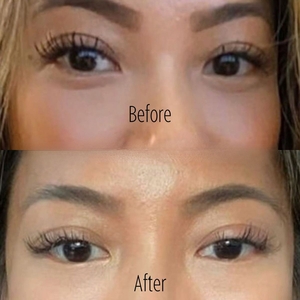 Jellyroll Tox (Infraorbital Crease) B/A-before