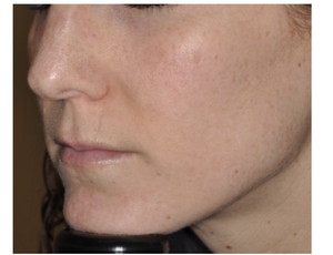 Skin Tone & Texture-after