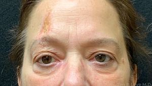 With scar revision and periorbital Morpheus/Fractora-before