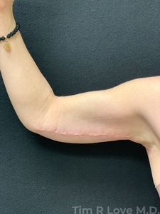 Brachioplasty-after
