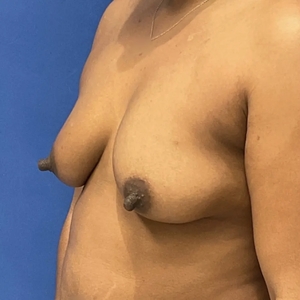 Breast Augmentation #3 400 cc-before