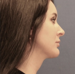 Lipo w Skin Tightening Face #1-after