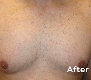 Laser Hair Removal #2-after
