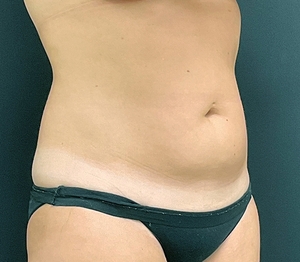 Liposuction #2-before