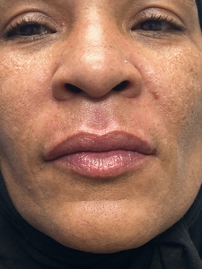 Lip filler Versa-before