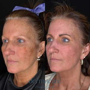 Halo - Carrie Labert PA-C-before