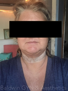 24 HOURS POST PROCEDURE-after