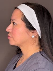 Irmalinda Garcia- Emface Sub/Cheeks-before