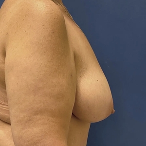 Breast Lift #2-before