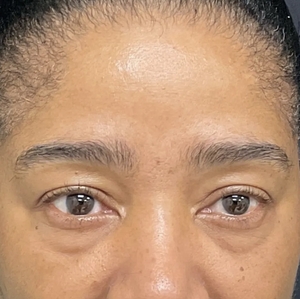 Brow & Eye Lift #3-before