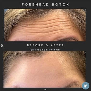 Botox-before