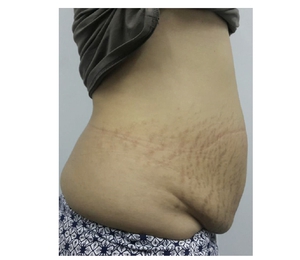 Body Contouring-before