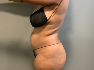 Denise Strickland Left Side-before