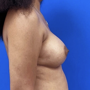 Breast Augmentation #14 325/350 cc-after