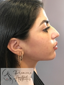 Radiesse Jawline-after