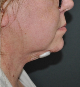 FaceTite & Liposuction 12 Days-after