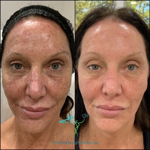 1 week post Treatment for hyperpigmentation, wrinkles, skin tightening-before