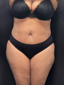 Lipo 360 + mini tummy tuck-before