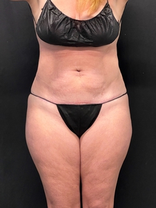 Lipo 360 + avelar tuck-after