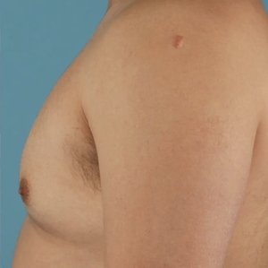 Male Breast Reduction #12 (left)-after
