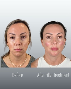 Filler B/A CL Frontal-before