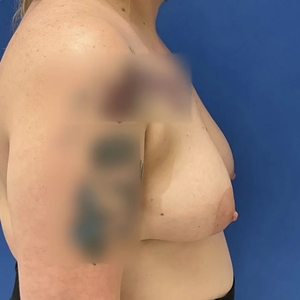 Breast Lift #1-before