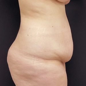 Tummy Tuck #7-before