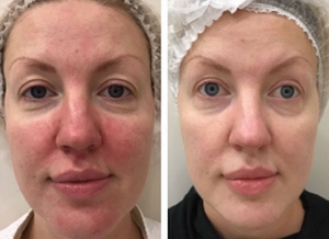 ROSACEA-before