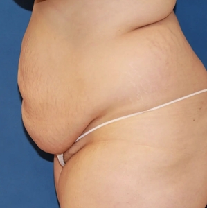 Tummy Tuck #6-before