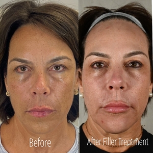 Filler B/A RB-before