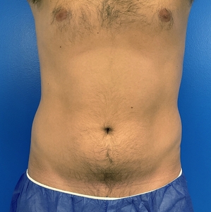 Liposuction #4-before