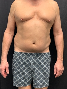 Male LAL lower abdomen + waist-after