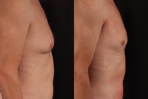 Male chest LAL w/ glandular excision-before