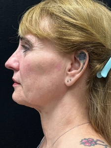 MyEllevate, Facetite, Morpheus8, Nanofat, Sculptra-after